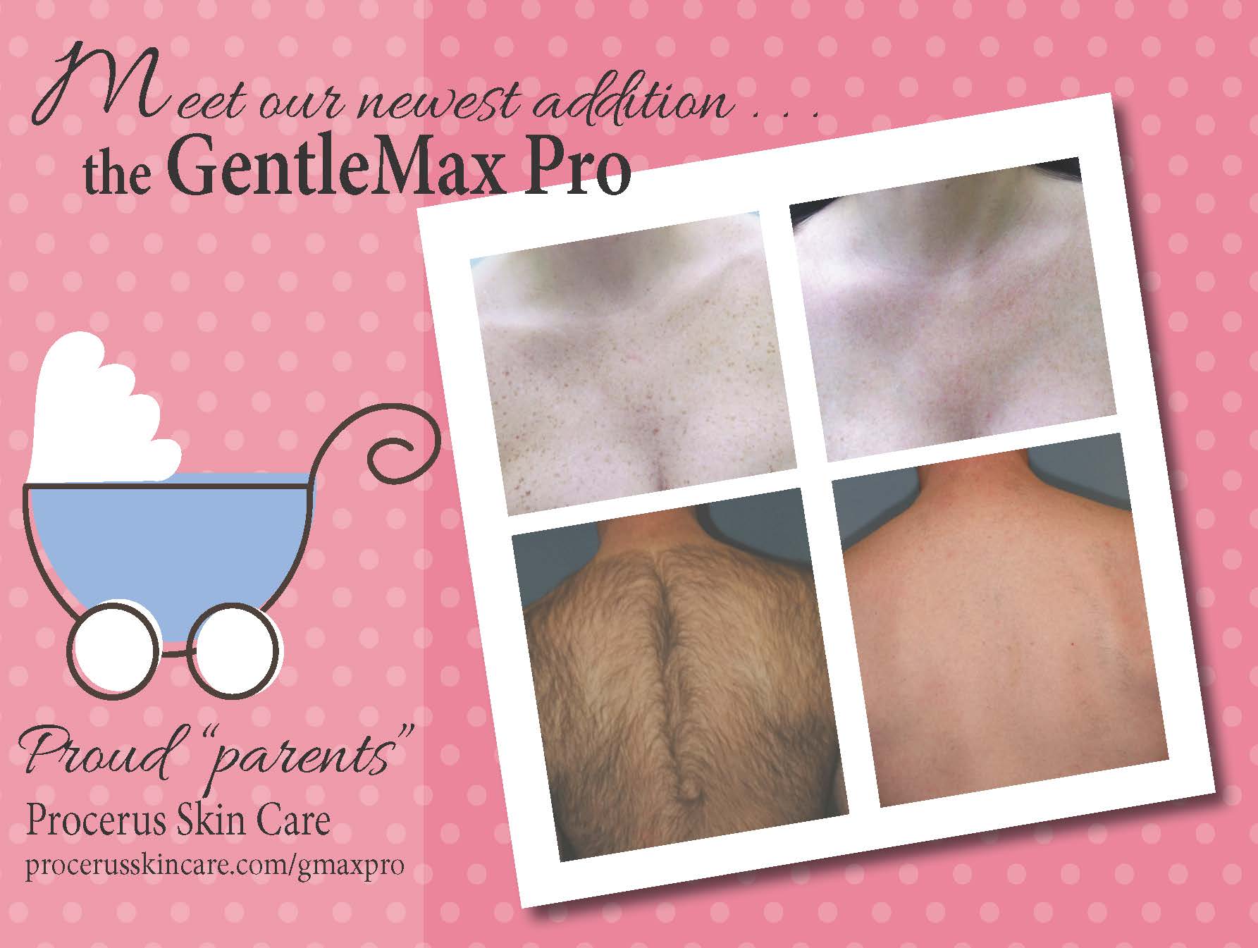 hair removal-gentlemax-pro