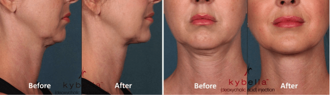 kybella before & after